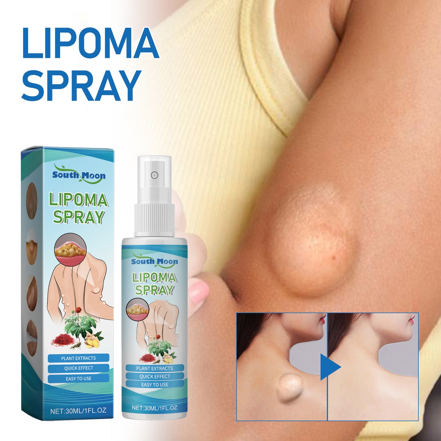 Lipoma Spray, Body Subcutaneous Fat Dredging Treatment To Relieve Lumps And Clumps