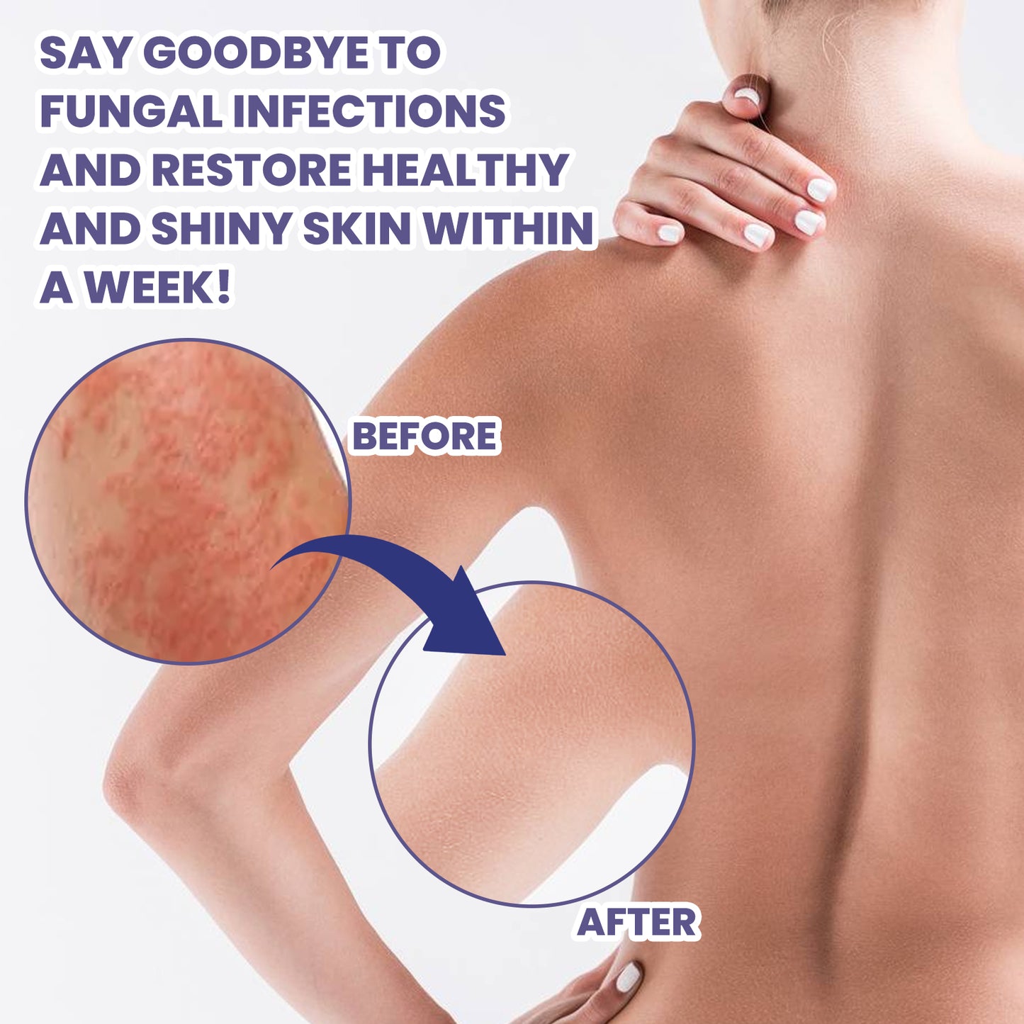 3 Days Aati Fungal Rash Cream, Repair Skin Barrier Soothe Moss Redness And Itchiness Moisturizing Skin Care Cream
