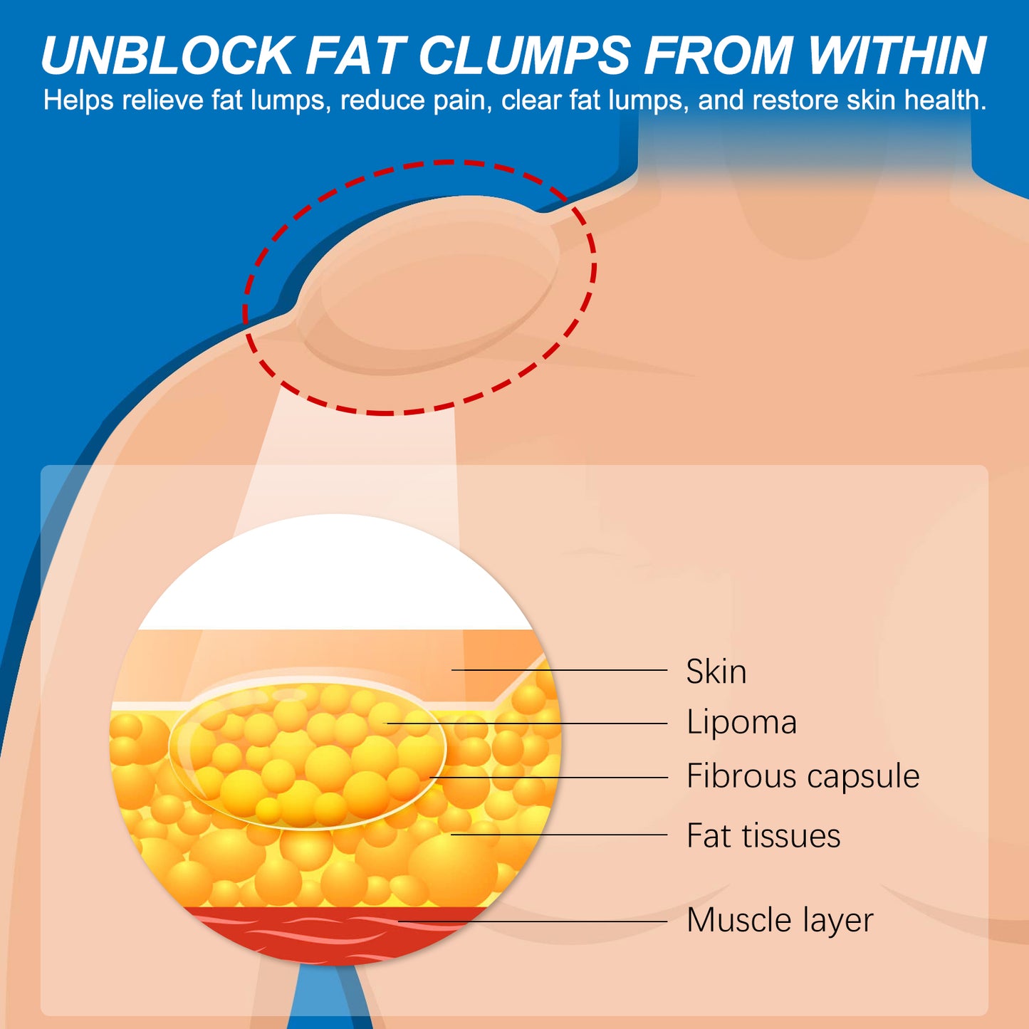 Lipoma Spray, Body Subcutaneous Fat Dredging Treatment To Relieve Lumps And Clumps