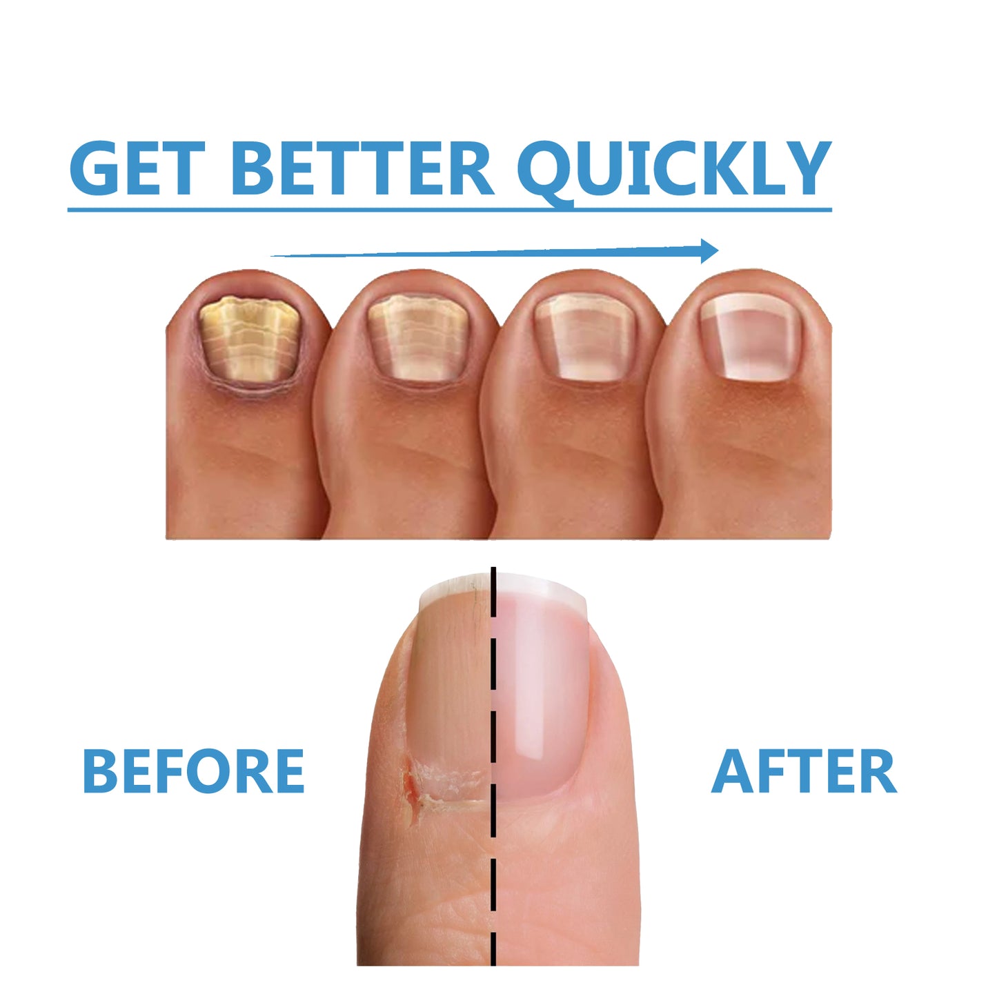 Toenail Fungus Treatment, Repair The Brotherhood Of Nails Rotten Jiasheng Mail This Soft Armour A Detailer