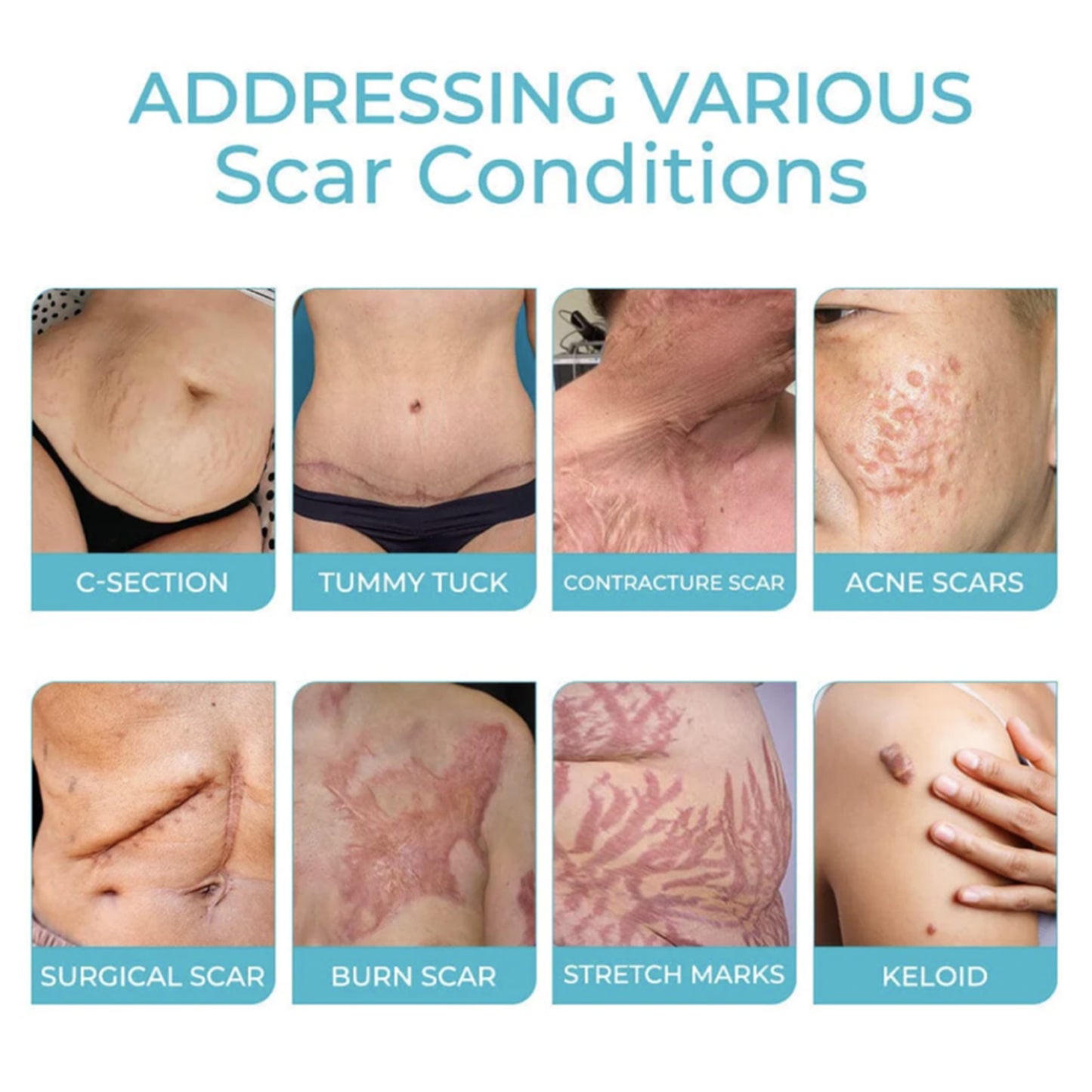 Scarfree Advanced Skin Spray, Body Skin Care Reduces Post-Natal Scars And Smooths Skin